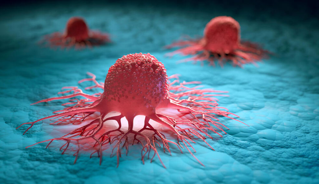 Imagen: La proteína del factor 4 derivada de células estromales (SDF-4) se ha encontrado que es un marcador de cáncer confiable (Fotografía cortesía de la Universidad de Nagoya)