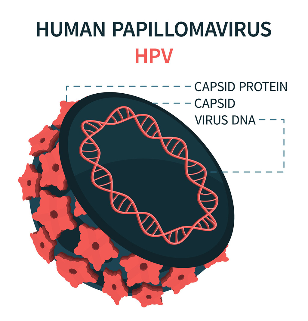 Imagen: El sensor electroquímico detecta HPV-16 y HPV-18 con alta especificidad (Fotografía cortesía de 123RF)