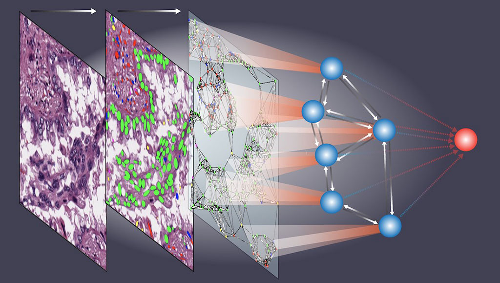 Imagen: El modelo de IA analiza la organización espacial celular para hacer diagnósticos y pronósticos del paciente (Fotografía cortesía de UT Southwestern)