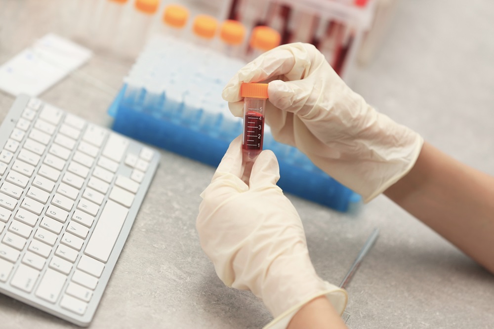Imagen: El análisis de sangre utiliza metilación del ADN libre celular para distinguir el subtipo neuroendocrino del cáncer de próstata avanzado (Fotografía cortesía de 123RF)