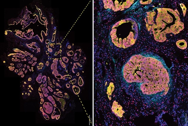 Imagen: Las células del estroma pueden ayudar a predecir la metástasis del cáncer de próstata (Fotografía cortesía de Weill Cornell)