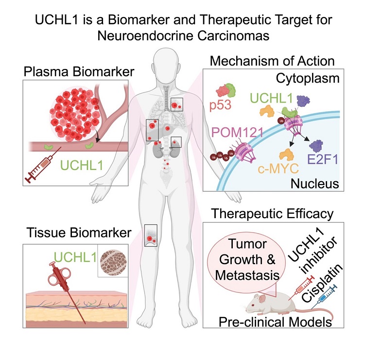 Imagen: La proteína UCHL1 podría conducir a un nuevo enfoque terapéutico para manejar carcinomas neuroendocrinos agresivos (Fotografía cortesía de Stoyanova, et al., doi.org/10.1016/j.xcrm.2023.101381)