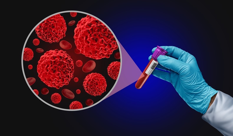 Imagen: La utilización de biopsias líquidas en la investigación del cáncer es un campo en rápido desarrollo (foto cortesía de Lightspring/Shutterstock)