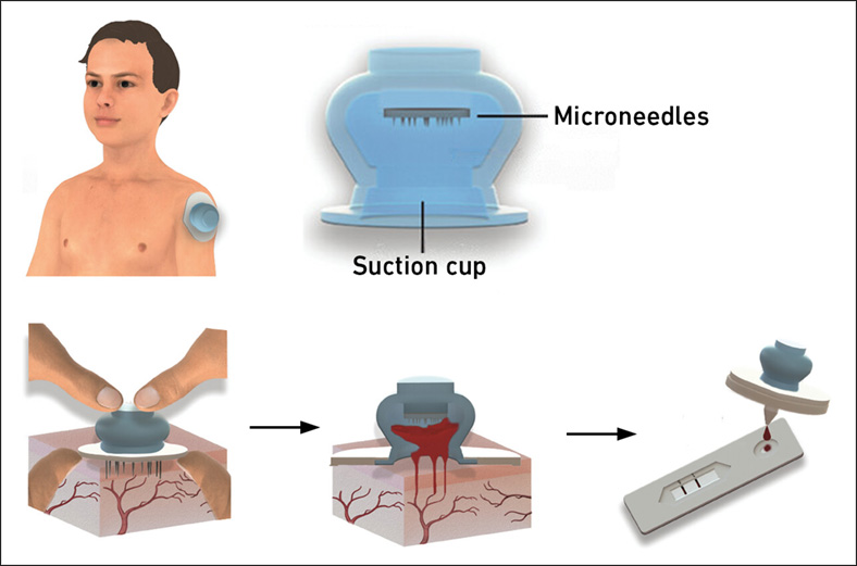 Imagen: El nuevo método es rápido y fácil, y también puede ser utilizado por personal no médico. (Foto cortesía de Zoratto et al. Advanced Science 2024, editado)