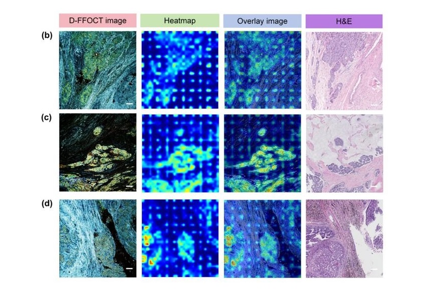 Imagen: Imágenes de carcinoma ductal invasivo, carcinoma mucinoso y carcinoma papilar (Foto cortesía de Science China Press)