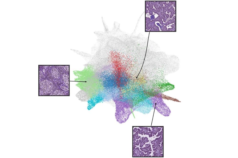 Imagen: Tres de 46 grupos de fenotipos histomorfológicos identificados por IA a partir de imágenes de tejido pulmonar canceroso (foto cortesía del Dr. N. Coudray/Nyu Grossman School of Medicine)