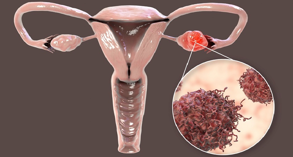 Imagen: El nuevo biomarcador podría allanar el camino para la detección temprana del cáncer de ovario (Foto cortesía de 123RF)