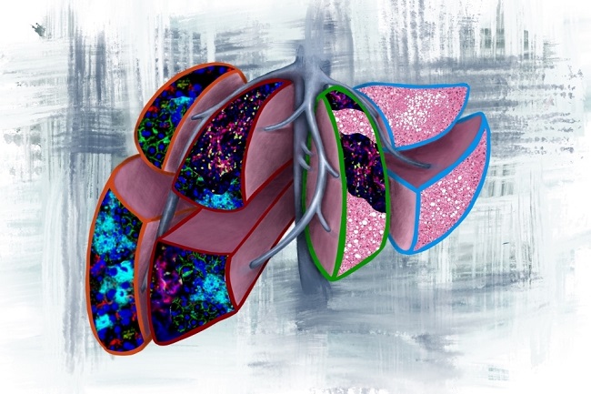 Imagen que ilustra cuatro escenarios pronósticos que pueden encontrarse en biopsias de hígado cuando se diagnostica cáncer de páncreas antes de la metástasis (Foto cortesía de Vanessa Dudley/Weill Cornell Medicine)