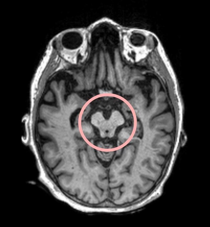 Imagen: Un escaneo cerebral que muestra la presencia de parálisis supranuclear progresiva en el área rodeada en rojo (foto cortesía de UCSF)