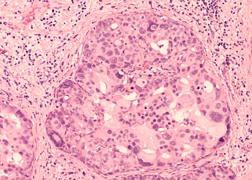 Imagen: El modelo de IA puede distinguir diferentes etapas del CDIS a partir de imágenes de tejido mamario económicas y fácilmente disponibles (Foto cortesía de David A. Litman/Shutterstock)