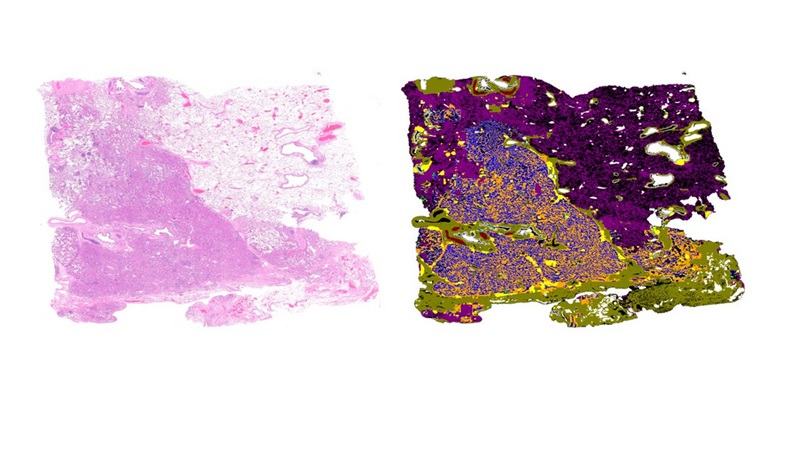 Imagen: La nueva plataforma digital basada en IA permite un análisis extremadamente rápido y preciso de las secciones de tejido de pacientes con cáncer de pulmón (foto cortesía del Dr. Yuri Tolkach)