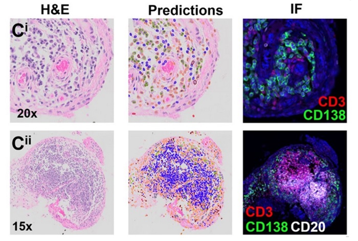 Imagen: El modelo de aprendizaje automático puede predecir células linfocitarias con alta precisión en portaobjetos de histología H&E (foto cortesía de Bell and Brindel, et al., 2024)