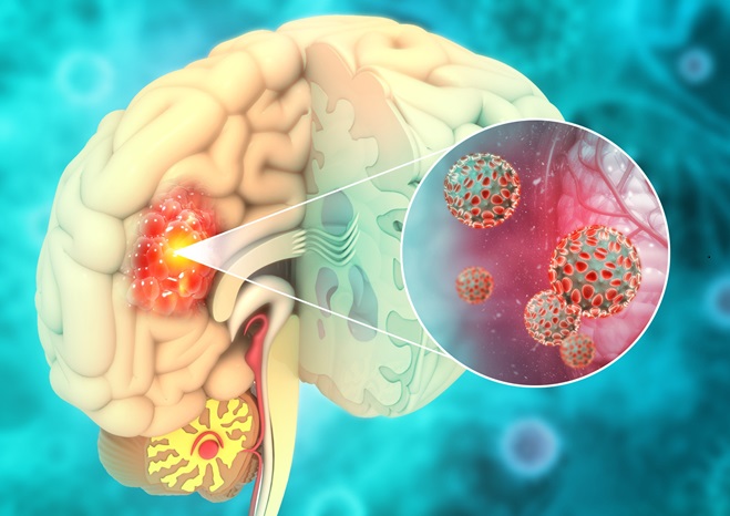 Se ha desarrollado un ensayo basado en la sangre para la detección de gliomas con la mutación IDH1.R132H  (Foto cortesía de 123RF)