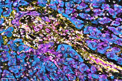 Imagen: los niveles bajos de NBR1 en las células estrelladas hepáticas mejoran la señalización de interferón en el carcinoma hepatocelular humano (foto cortesía de los laboratorios de Moscat y Diaz-Meco)