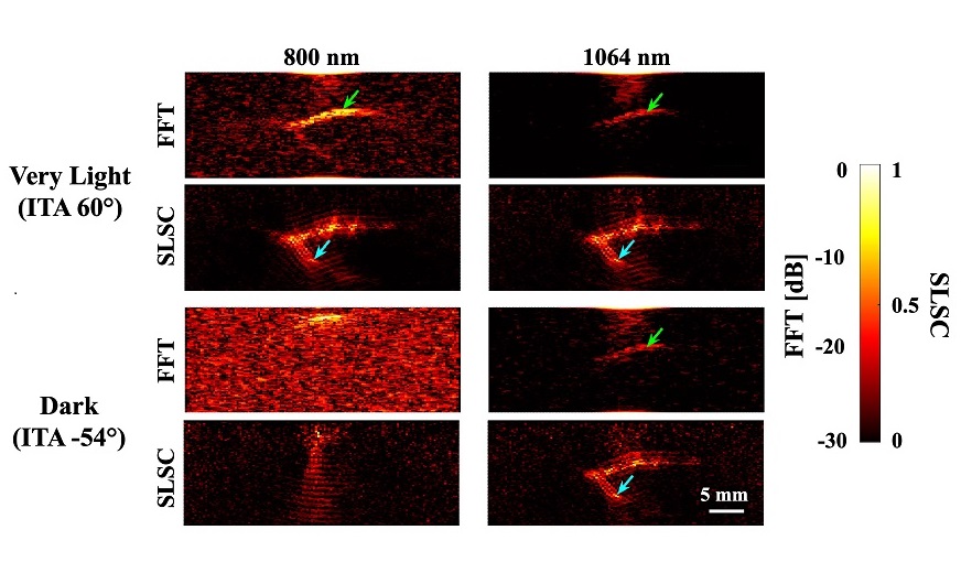 Imagen: Imágenes fotoacústicas de una estructura de vaso extendido subyacente a los tonos de piel muy claros y oscuros (Foto cortesía de Asquinha, Gubbi y Bell, doi 10.1117/1.BIOS.2.1.012502)