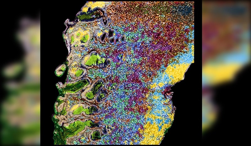 Imagen: Patho-DBiT revela la arquitectura de tejido a nivel celular de una muestra agresiva de linfoma gástrico almacenada durante 3 años (Foto cortesía de Yale)