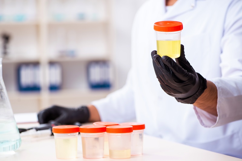 Imagen: Primera prueba de orina del mundo para el cáncer de pulmón selecciona células  'zombis' (Foto cortesía de Shutterstock)