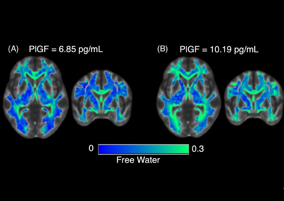 Imagen: ejemplos representativos de imágenes FW (Foto cortesía de Alzheimer’s & Dementia, doi.org/10.1002/alz.14408)