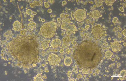 Imagen: los nuevos enfoques contra el cáncer de mama metastásico involucran mini tumores de células cancerosas circulantes (foto cortesía de Trumpp/DKFZ)