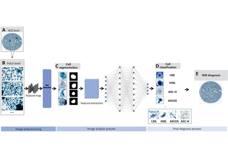 Imagen: Representación esquemática del análisis de imágenes de citología cervical asistido por IA (Foto cortesía de Cancer Biology & Medicine, DOI:10.20892/j.issn.2095-3941.2024.0198)