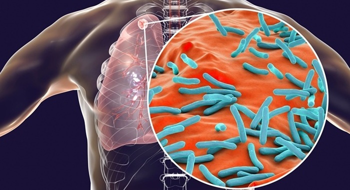 Imagen: la sensibilidad diagnóstica del ensayo de liberación de interferón-γ fue mayor en pacientes con EPOC complicada con tuberculosis pulmonar activa (foto cortesía de Adobe Stock)