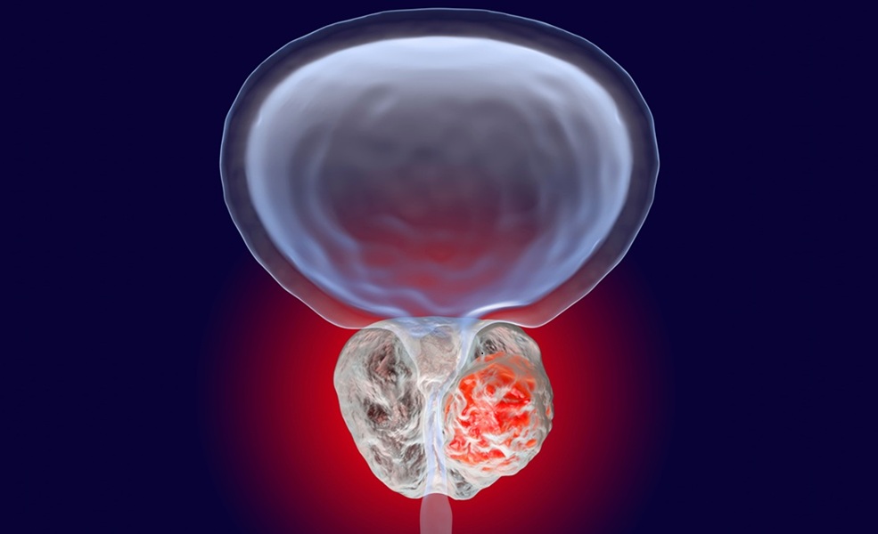 Imagen: la prueba proporciona una estimación mejorada del riesgo de recurrencia de cáncer de próstata de un paciente (foto cortesía de Adobe Stock)