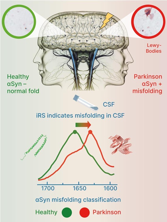 Imagen: los investigadores demostraron que el plegado incorrecto de la alfa-sinucleína puede detectar con precisión Parkinson en LCR (foto cortesía de la Universidad del Ruhr Bochum)