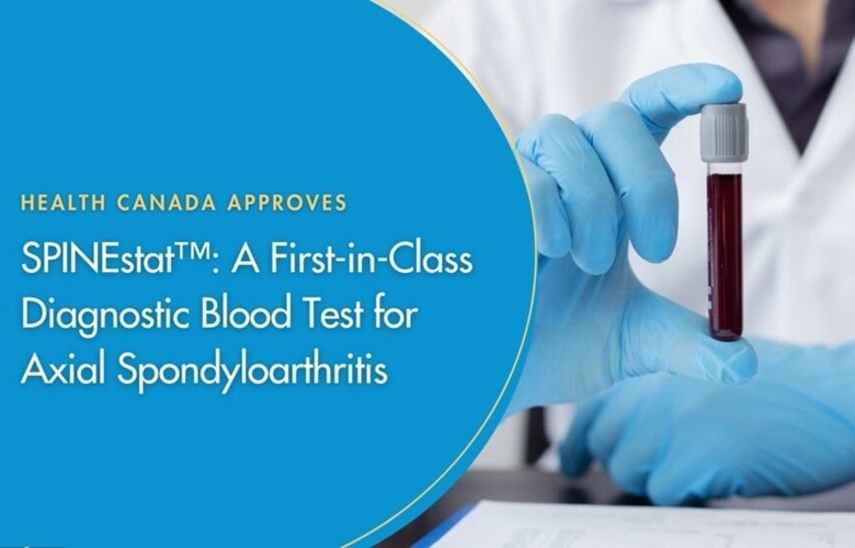 Imagen: Health Canada ha aprobado SPINEstat, una prueba de sangre diagnóstica de primera clase para la espondiloartritis axial, como un dispositivo médico de clase II (foto cortesía de Augurex)