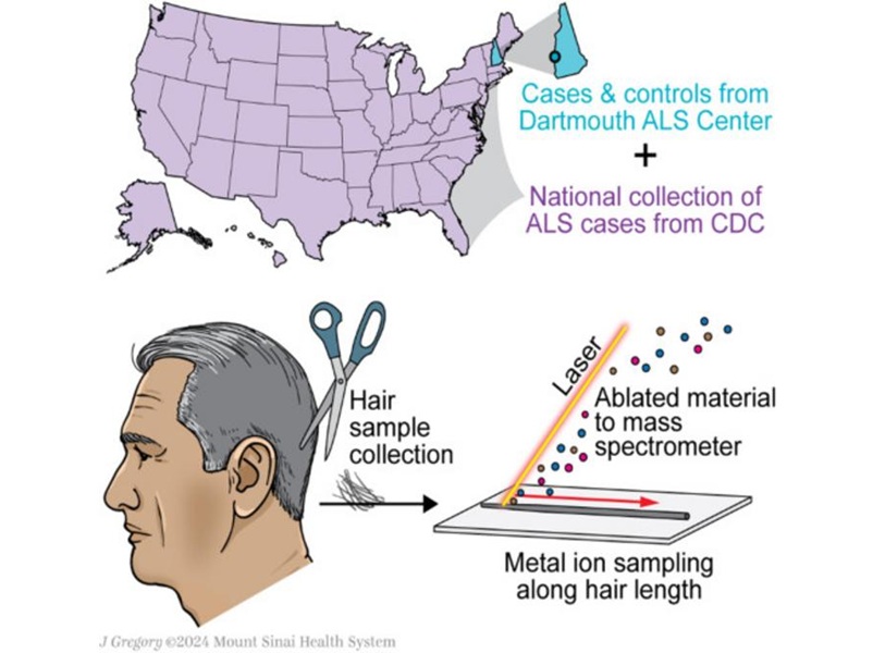 Imagen: las muestras de cabello se recogieron de casos positivos de ELA y controles negativos de ELA (foto cortesía del Sistema de Salud Mount Sinai)