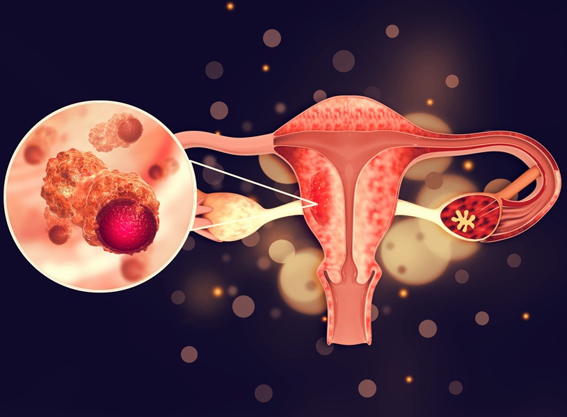 Imagen: la prueba analiza los biomarcadores en el líquido uterino para detectar el cáncer de endometrio (foto cortesía de 123RF)