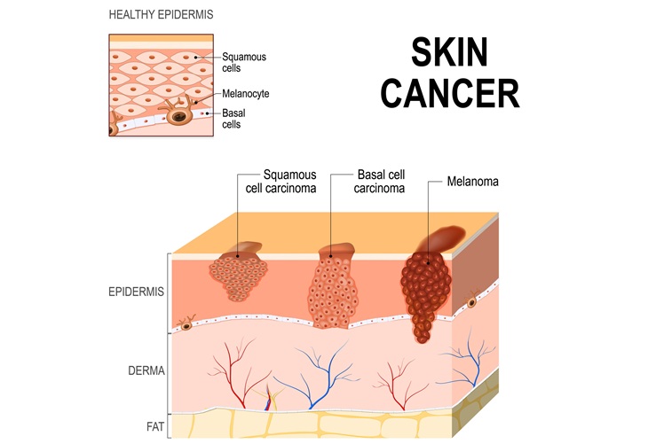 Imagen: la prueba genómica mide ocho actividades genéticas en un tumor de melanoma y combina estos datos con factores del paciente como la edad y el grosor del tumor (fotografía cortesía de 123RF)