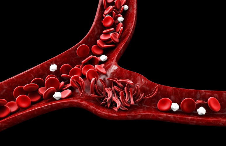 Imagen: se descubrió que los pacientes con anemia falciforme con niveles más altos de RMV, AMV y EMV tenían una enfermedad más grave (fotografía cortesía de Adobe Stock)