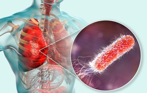 Imagen: nuevos conocimientos de un estudio vinculan los marcadores sanguíneos y las bacterias de las vías respiratorias con el riesgo de exacerbación de la EPOC (fotografía cortesía de Shutterstock)