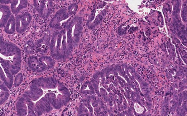 Imagen: el modelo de IA utiliza diapositivas de patología de rutina para predecir la respuesta al tratamiento del cáncer de recto (fotografía cortesía de UCL)