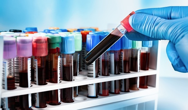 Imagen: el nuevo análisis de muestras de sangre vincula patrones de proteínas específicos con el riesgo de mortalidad a cinco y diez años (fotografía cortesía de Adobe Stock)