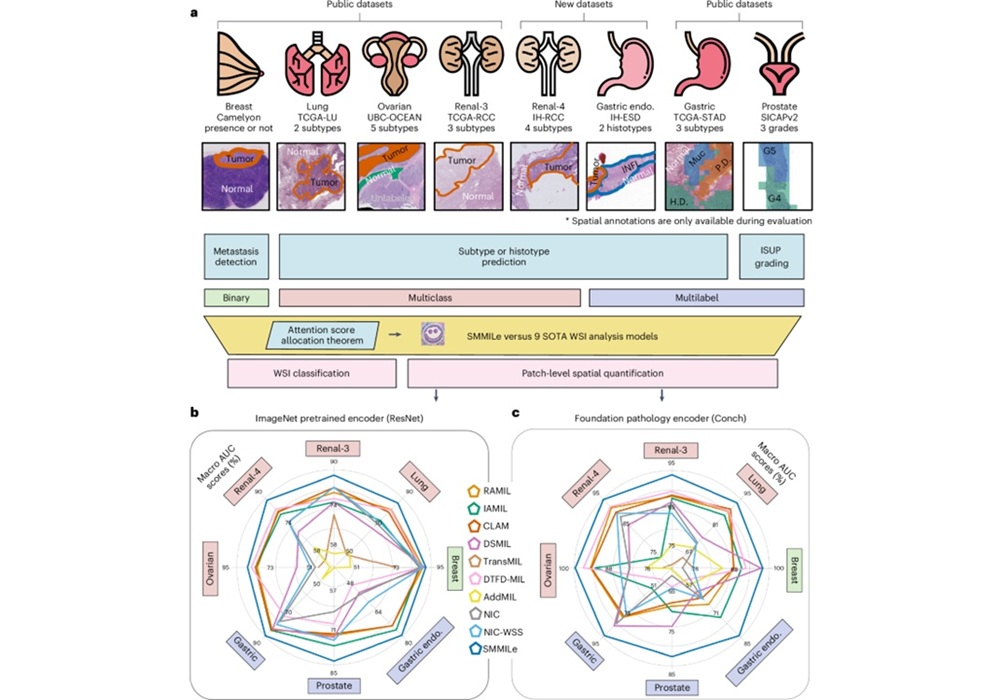 Imagen: SMMILe permite una cuantificación espacial precisa en patología digital mediante el aprendizaje de instancias múltiples (Gao, Z et al. Nature Cancer, 2025; DOI: 10.1038/s43018-025-01060-8)