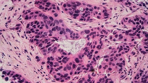 Imagen: el sistema de IA utiliza análisis de imágenes de doble resolución para identificar el cáncer de mama con mayor precisión que las herramientas de IA convencionales (fotografía cortesía de Shutterstock)