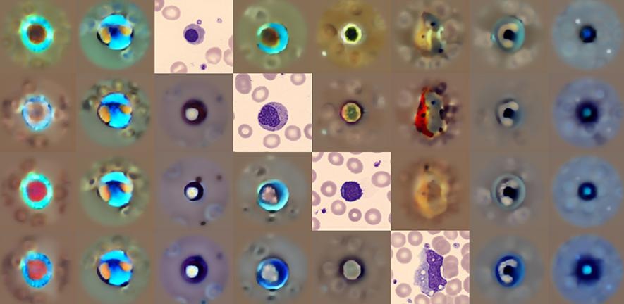 Imagen: la herramienta de IA puede analizar anomalías en la forma y estructura de las células sanguíneas (Simon Deltadahl et al. Nature Machine Intelligence (2025). DOI: 10.1038/s42256-025-01122-7)