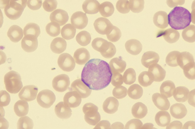 Imagen: las células recién descubiertas explican por qué algunos niños con leucemia linfoblástica aguda no responden bien al tratamiento (fotografía cortesía de Shutterstock)