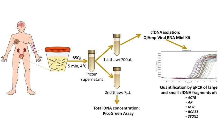Imagen: el análisis de patrones específicos de fragmentación del ADNlc en muestras de orina puede diagnosticar y estadificar el cáncer de vejiga (Herranz et al., The Journal of Molecular Diagnostics, DOI: 10.1016/j.jmoldx.2025.08.010)
