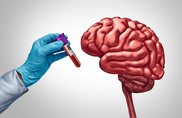 Imagen: las condiciones de salud cotidianas pueden influir en los resultados de los análisis de sangre de Alzheimer (fotografía cortesía de Shutterstock)