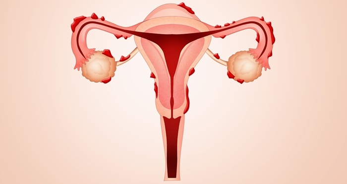 Imagen: la prueba de sangre no invasiva puede confirmar la presencia de endometriosis entre mujeres sintomáticas (fotografía cortesía de Adobe Stock)