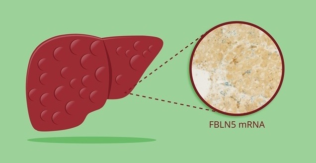 Imagen: la detección de FBLN5 en células estrelladas hepáticas humanas podría actuar como una señal de advertencia temprana de daño hepático (fotografía cortesía de la Universidad Metropolitana de Osaka)