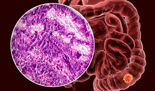 Imagen: una simple extracción de sangre podría ayudar a guiar las decisiones de tratamiento personalizadas después de una cirugía de cáncer de colon (fotografía cortesía de 123RF)