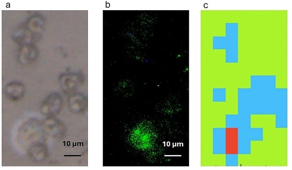 Imagen: la microespectroscopia infrarroja avanzada permite la detección de células tumorales circulantes individuales en muestras de sangre (Dowling L, et al., Applied Spectroscopy (2025). DOI: 10.1177/00037028251390565)