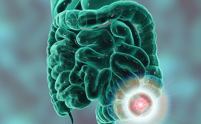 Imagen: el análisis de ADN de pólipos colorrectales puede mejorar el diagnóstico de cáncer hereditario (fotografía cortesía de Adobe Stock)