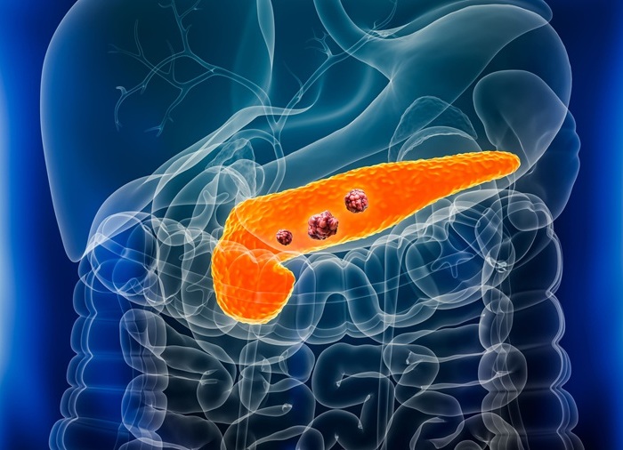 Imagen: el análisis genético puede revelar cómo la disfunción del sistema del complemento puede influir en el riesgo de cáncer de páncreas (fotografía cortesía de Adobe Stock)