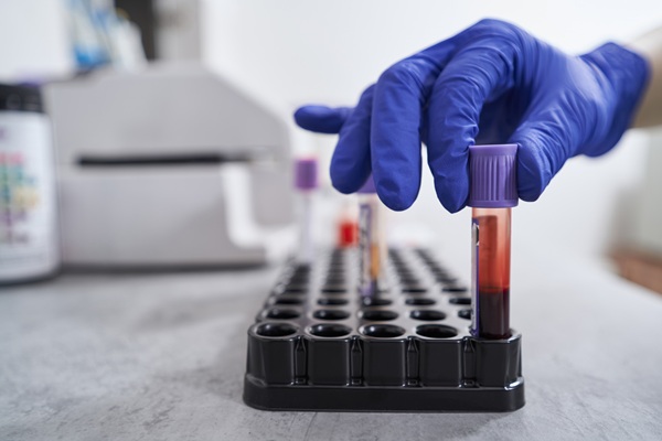 Imagen: los marcadores epigenéticos en la sangre podrían ayudar a identificar a los prediabéticos que enfrentan el mayor riesgo de diabetes y complicaciones (fotografía cortesía de 123RF)