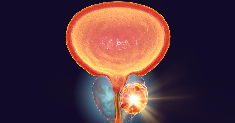 Imagen: el nuevo modelo tiene como objetivo identificar a los pacientes con cáncer de próstata que probablemente se beneficiarán del tratamiento (fotografía cortesía de Adobe Stock)