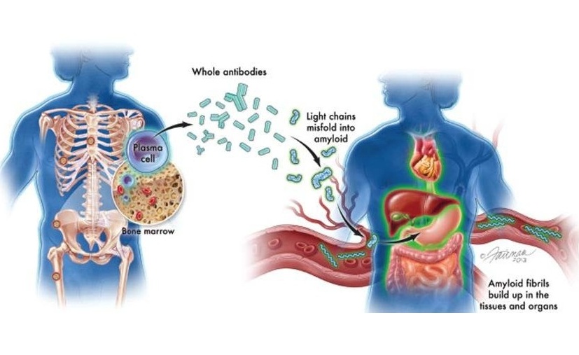 Imagen: la amiloidosis AL es un trastorno de la médula ósea poco común y potencialmente mortal (Wangsa, SP et al., Bioscientia Medicina; doi.org/10.37275/bsm.v7i11.889)